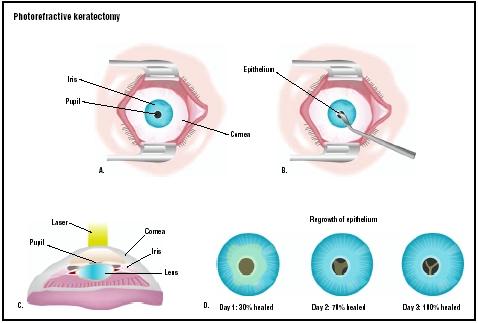In PRK surgery, the eye is held open with a speculum (A). The gel-like coating on the eye, called the epithelium, is scraped away (B). A laser is used to reshape the cornea and improve vision (C). The epithelium repairs itself in a few days (D). (Illustration by GGS Inc.)