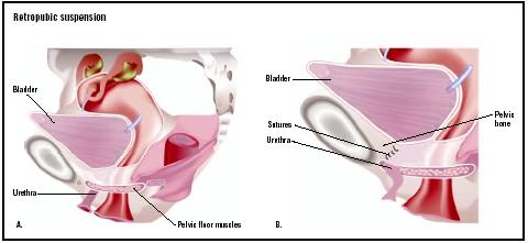 Weak pelvic floor muscles (A) can cause stress incontinence. In a retropubic suspension, the neck of the bladder is elevated and stitched to the pubic bone to hold it in place (B). (Illustration by GGS Inc.)