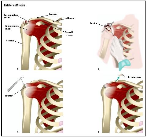 A rotator cuff injury results in a torn tendon at the top of the shoulder 