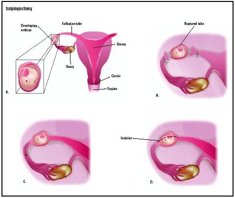 A tubal or ectopic pregnancy can be removed in several ways. If the fallopian tube is ruptured (A), the tube is tied off on both sides, and the embryo removed. If the tube is intact, the embryo can be pulled out the end of the tube (C), or tube can be cut open and the contents removed (D). (Illustration by GGS Inc.)