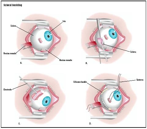 In a scleral buckling procedure, one of the eye's rectus muscles are severed to gain access to the sclera (A). The sclera is cut open (B), and an electrode is applied to the area of retinal detachment (C). A silicone buckle is threaded into place beneath the rectus muscles (D), and the severed muscle is repaired. (Illustration by GGS Inc.)