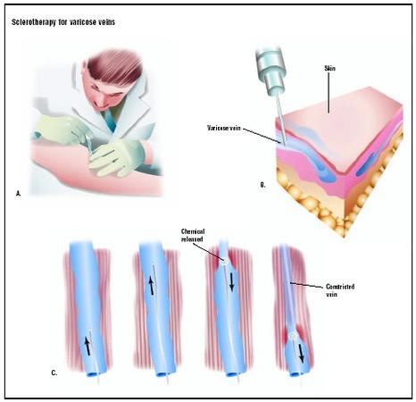 During sclerotherapy for the treatment of varicose veins, the doctor injects a chemical solution directly into the vein (A and B). The needle travels up the vein, and as it is pulled back, the chemical is released, causing the vein to form fibrous tissue that collapses the inside of it (C). (Illustration by GGS Inc.)
