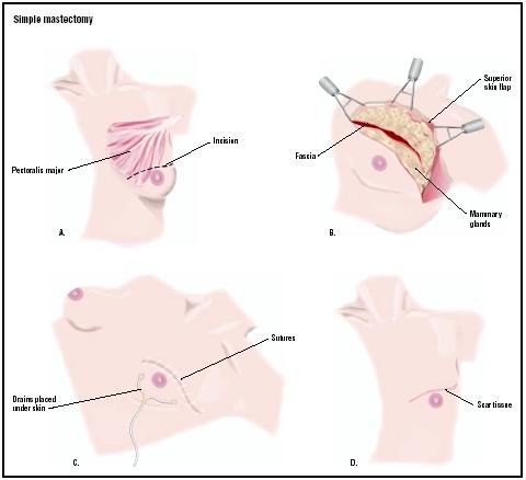In a simple mastectomy, the skin over the tumor is cut open (A). The tumor and tissue surrounding it are removed (B), and the wound is closed (C). (Illustration by GGS Inc.)