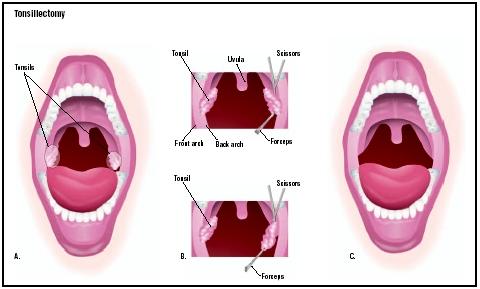 Tonsils are removed through the mouth (A). The surgeon uses a scissors to cut away the tonsils, and a forceps to pull them away (B). (Illustration by GGS Inc.)