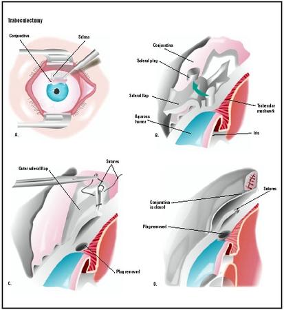During a trabeculectomy, the patient's eye is held open with a speculum. The outer layer, or conjunctiva, and the white of the eye, or sclera, are cut open (A). A superficial scleral flap is created and a plug of sclera and underlying trabecular network is removed (B). This allows the fluid in the eye to circulate, relieving pressure. The scleral flap is closed and sutured (C). The conjunctiva is closed (D). (Illustration by GGS Inc.)