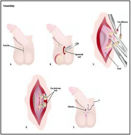 In a vasectomy, an incision is made in the man's scrotum. The spermatic cord is pulled out (B) and incised to expose the vas deferens, which is then severed (C). The ends may be cauterized or tied off (D). After the procedure is repeated on the opposite cord, the scrotal incision is closed (E). (Illustration by GGS Inc.)