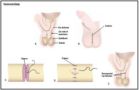 In a vasovasostomy, the surgeon makes an incision in scrotum at the site of the vasectomy scar (B). The spermatic cords are located, and the two vas deferens are reconnected with two layers of suture (C and D). (Illustration by GGS Inc.)