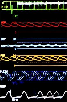 Normal vital signs, from the top: heart rate, arterial blood pressure (ABP), central venous pressure (CVP), pulmonary artery pressure (PAP), blood oxygen (PLETH), and respiration rate. (Photograph by James King-Holmes. Science Source/Photo Researchers. Reproduced by permission.)