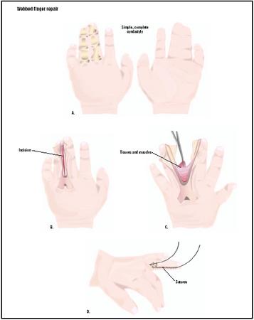 This webbed finger shows a simple, complete syndactyly, meaning the bones for two fingers are complete, and only the soft tissues form the webbed section (A). To repair this, an incision is made in the skin of the webbing (B). Tissues and muscles are severed (C), and the two separated fingers are stitched (D). (Illustration by GGS Inc.)