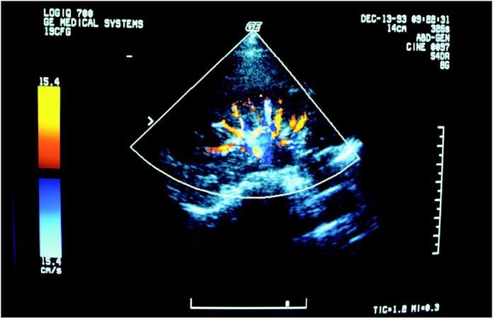 An ultrasound screen shows a patient's kidney. (Photograph by Brownie Harris. The Stock Market. Reproduced by permission.)