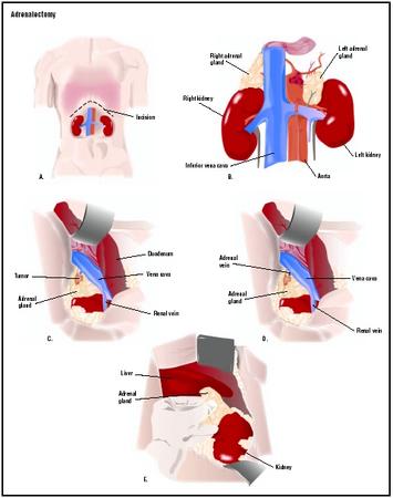 To remove the adrenal glands, an incision is made below the patient's ribcage (A). The adrenal gland, which sits on top of the kidney (B), is visualized (C). The vein emerging from the gland is tied off and cut (D), and the adrenal gland is removed (E). (Illustration by GGS Inc.)