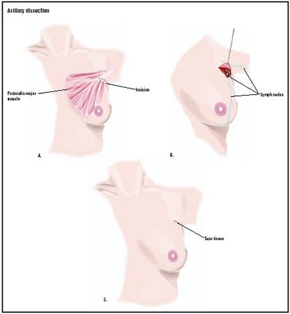 To determine the advancement of breast cancer, lymph nodes in the armpit are removed. An incision is made (A), and lymph nodes are removed and tested (B), leaving a small scar (C). (Illustration by GGS Inc.)