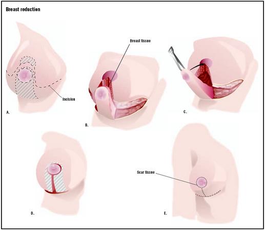 In a breast reduction surgery, the breast tissue is cut along predetermined lines and (A) excess tissue is removed (B). The nipple is placed higher on the breast (C), and the two sides of the incision are brought together (D), removing any excess skin (E). (Illustration by GGS Inc.)