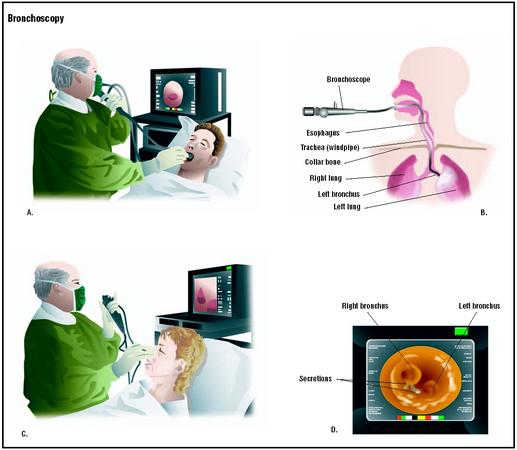 Bronchoscopy can be performed via the patient's mouth (A) or through the nose (C). During the procedure, the scope is fed down the trachea and into the bronchus leading to the lungs (B), providing the physician with a view of internal structures (D). (Illustration by GGS Inc.)