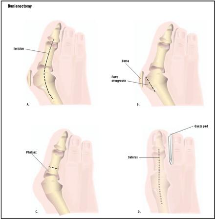 A bunion results in a bony overgrowth in the foot, causing the big toe to curve outward. To repair this, an incision is made in the top of the foot (A). The overgrowth and fluid-filled sac called a bursa are removed (B). The phalanx bone of the big toe is shortened to straighten it (C). The foot is realigned, and the incision is closed (D). (Illustration by GGS Inc.)