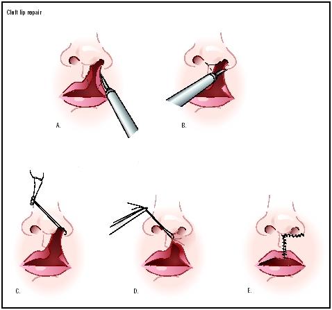 The edges of the cleft between the lip and nose are cut (A and B). The bottom of the nostril is formed with suture (C). The upper part of the lip tissue is closed (D), and the stitches are extended down to close the opening entirely (E). (Illustration by Argosy.)