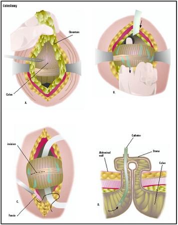 To perform a colostomy, the surgeon enters the abdomen and locates the colon, or large intestine (A). A loop of the colon is pulled through the abdominal incision (B); then the colon is cut to allow the insertion of a catheter (C). The skin and tissues are closed around the new opening, called a stoma (D). (Illustration by GGS Inc.)