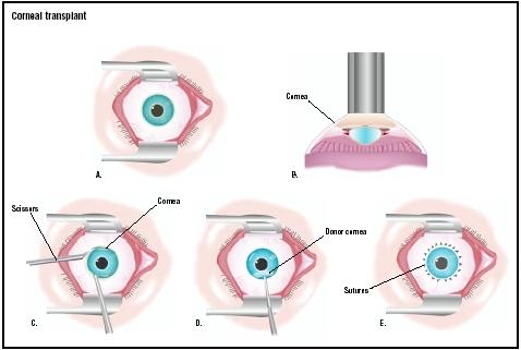 In a corneal transplant, the eye is held open with a speculum (A). A laser is used to make an initial cut in the existing cornea (B). The surgeon uses scissors to remove it (C), and a donor cornea is placed (D). It is stitched with very fine sutures (E). (Illustration by GGS Inc.)