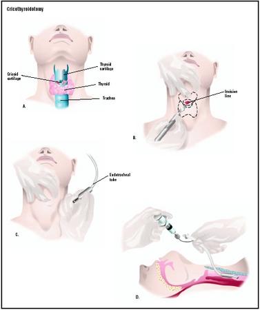 To perform a cricothyroidotomy, the surgeon makes an incision into the cricoid cartilage of the throat (B). The incision is held open while an endotracheal tube is inserted (C). The tube is secured in the trachea to maintain an airway for the patient (D). (Illustration by GGS Inc.)