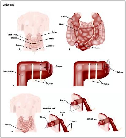 In a cystectomy with ileal conduit, an incision is made in the patient's lower abdomen (A). The ureters are disconnected from the bladder, which is then removed (B). They are then attached to a section of ileum (small intestine) that has been removed and refashioned for that purpose (C). A stoma, or hole in the abdominal wall, is created at the site to allow drainage of the urine (D). (Illustration by GGS Inc.)