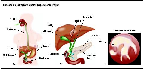 In endoscopic retrograde cholangiopancreatography, an endoscope is introduced into the patient's mouth and fed through the esophagus, stomach, and duodenum (small intestine) (A). A dye is released into the ducts (B). A series of x rays is taken, and a tumor may be visible with the endoscope (C). (Illustration by GGS Inc.)