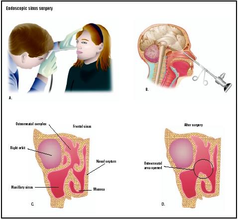 During endoscopic sinus surgery, a doctor uses an endoscope to view the inner cavities of the nose (A and B). Using special instruments, the doctor opens the sinuses to alleviate problems with sinusitis (C and D). (Illustration by GGS Inc.)