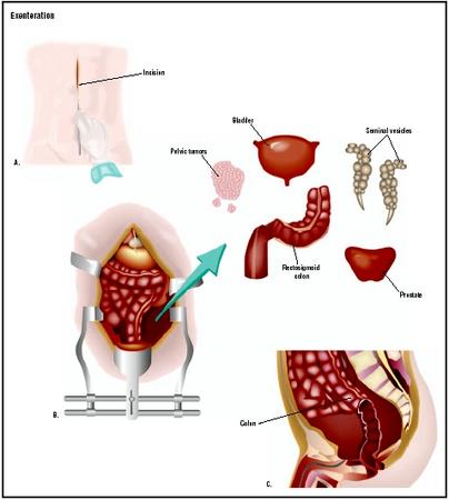 A large abdominal incision exposes abdominal and pelvic contents for pelvic exenteration (A). Contents of the lower abdominal cavity, including the rectosigmoid colon, prostate and seminal vesicles (if male), bladder, and any pelvic tumors are removed (B). (Illustration by GGS Inc.)