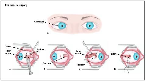 To repair a convergent gaze, the ophthalmogist cuts the muscles that move the eye from side to side (A). On one side, the muscles are attached further back on the eyeball (B). On the other, the muscle is shortened (C) and stitched (D). (Illustration by GGS Inc.)