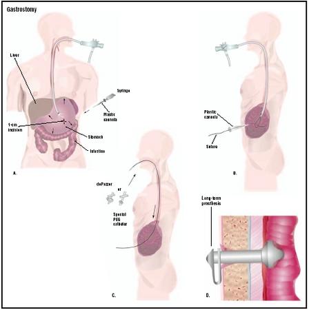 For a percutaneous endoscopic gastrostomy procedure, the stomach is inflated with air (A). An incision is made into the abdomen and the stomach, and a plastic cannula is inserted (B). A catheter is inserted into the patient's mouth, pulled down the esophagus, and into the stomach (C). When the catheter is in place, access to the stomach is maintained (D). (Illustration by GGS Inc.)