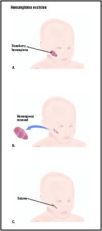 To remove a hemangioma that is very large or in a troublesome area (A), the surgeon makes an incision around the mark (B), then closes the skin around it (C). (Illustration by GGS Inc.)