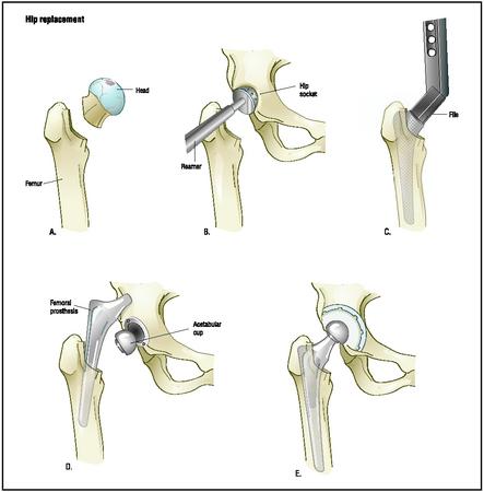 In a hip replacement, the upper leg bone, or femur, is separated from the hip socket, and the damaged head is removed (A). A reamer is used to prepare the socket for the prosthesis (B). A file is used to create a tunnel in the femur for the prosthesis (C). The hip and socket prostheses are cemented in place (D), and finally connected (E). (Illustration by Argosy.)