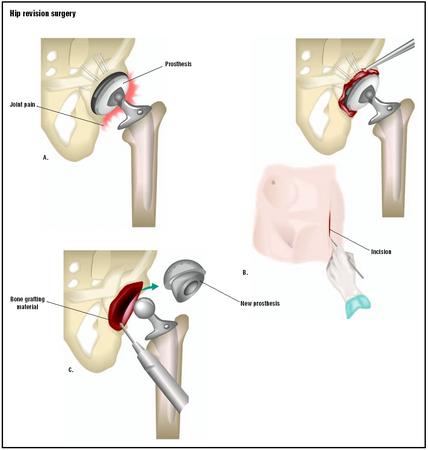 Degeneration of the joint around the prosthesis causes pain for some patients who have undergone hip replacement (A). To repair it, an incision is made in the hip and the old prosthesis is removed (B). Bone grafts may be planted in the hip, and a new prosthesis is attached (C). (Illustration by GGS Inc.)