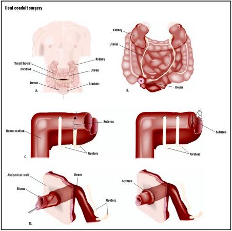 In a cystectomy with ileal conduit, an incision is made in the patient's lower abdomen (A). The ureters are disconnected from the bladder, which is then removed (B). They are then attached to a section of ileum (small intestine) that has been removed and refashioned for that purpose (C). A stoma, or hole in the abdominal wall, is created at the site to allow drainage of the urine (D). (Illustration by GGS Inc.)