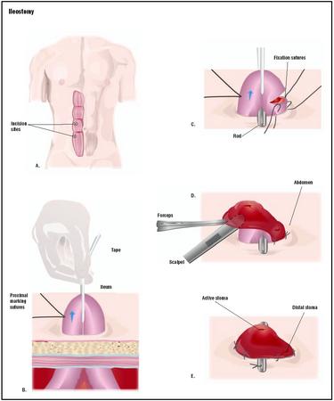 An ileostomy can be placed in different sites on the abdomen (A). Once the incision is made, the ileum is pulled through the incision (B), and a rod is placed under the loop. The loop is cut open, one side is stitched to the abdomen (C). The portion of intestine is flipped open to expose the interior surface (D), and the opposite side is stitched in place (E). (Illustration by GGS Inc.)