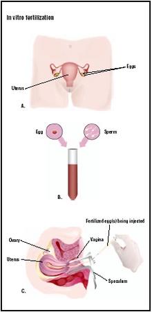 For in vitro fertilization, hormones are administered to the patient, and then eggs are harvested from her ovaries (A). The eggs are fertilized by sperm donated by the father (B). Once the cells begin to divide, one or more embryos are placed into the woman's uterus to develop (C). (Illustration by GGS Inc.)