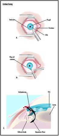 For an iridectomy, an incision is made in the cornea just below the iris (A). A piece of the iris is removed (B). This allows fluid to flow between the areas to the front and rear of the iris (C). (Illustration by GGS Inc.)