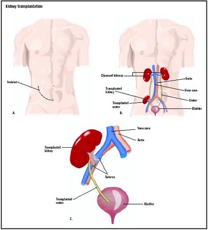 For a kidney transplant, an incision is made in the lower abdomen (A). The donor kidney is connected to the patient's blood supply lower in the abdomen than the native kidneys, which are usually left in place (B). A transplanted ureter connects the donor kidney to the patient's bladder (C). (Illustration by GGS Inc.)