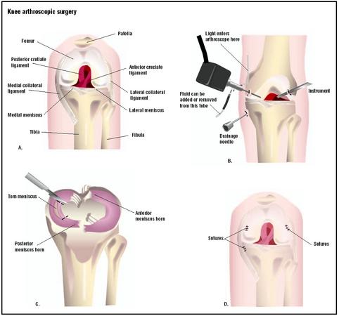 Step A shows the anatomy of the knee from the front with the leg bent. To repair a torn meniscus, three small incisions are made into the knee to admit laparoscopic instruments (B). Fluid is injected into the joint to aid in the operation. The injury is visualized via the instruments, and the torn area is removed (C). (Illustration by GGS Inc.)