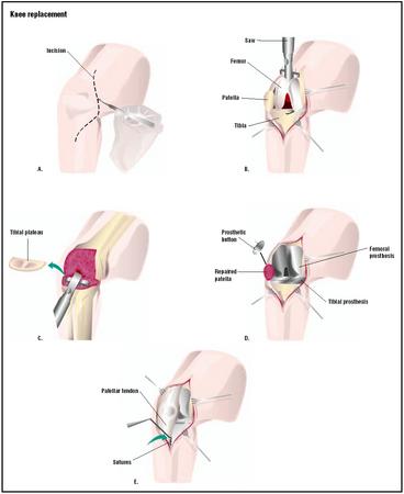 In a total knee replacement, an incision is made to expose the knee joint (A). The surfaces of the femur are cut with a saw to receive the prosthesis (B). The tibia is cut to create a plateau (C). The prostheses for the femur, tibia, and patella are put in place (D). The incision is closed (E). (Illustration by GGS Inc.)