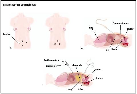 For this procedure, three or four incisions may be made in the woman's lower abdomen (A). Carbon dioxide is pumped into the abdomen to create a condition called pneumoperitoneum, which gives the surgeon more room to work (B). A laparoscope with video monitor is used to view the internal structures, while endometrial growths are removed with other tools (C). (Illustration by GGS Inc.)