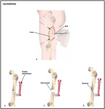 To lengthen a leg surgically, an incision is made in the leg to access the femur (A). A surgical drill is used to weaken the femur so the surgeon can break it. During the operation, screws are drilled into the bone on both sides of the break, and an external fixator is applied (B). The gap between the two pieces of bone is increased gradually (C), so new bone growth results in a longer leg (D). (Illustration by GGS Inc.)