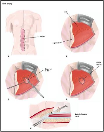 In a traditional liver biopsy, access to the liver is gained through an incision in the abdomen (A).The liver is exposed (B). A wedge-shaped section is cut into the liver and removed (C).The liver incision is stitched (D).The abdominal incision is then repaired (E). (Illustration by GGS Inc.)