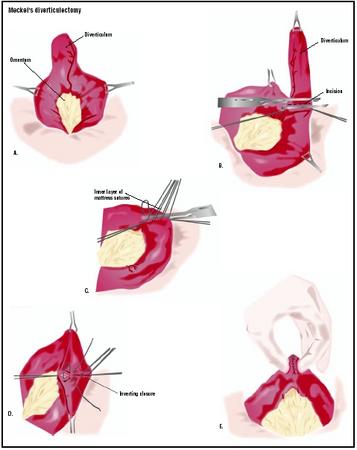 During Meckel's diverticulectomy, the abdomen is opened above the area of the diverticulum, which is exposed along with the bowel (A). The diverticulum is clamped off at the base, and then cut off (B). Two layers of stitches are used to repair the bowel (C and D). (Illustration by GGS Inc.)