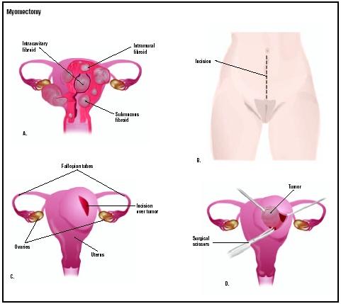 Uterine fibroids can occur within the uterine cavity, in the mucous layer, or in the muscle (A). To remove them by myomectomy, an incision is made into the woman's lower abdomen (B). An incision is made in the uterus over the tumor (C), and it is removed (D). (Illustration by GGS Inc.)