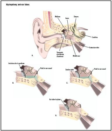 During a myringotomy, an incision is made into the ear drum, or tympanic membrane (B). The fluid in the ear canal is suctioned out (C), and a small tube is put in place to allow future drainage in the event of an infection (D). (Illustration by GGS Inc.)
