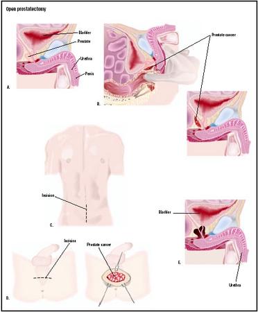 During a digital rectal exam (B), the doctor may feel an enlargement of the prostate that can be benign or cancerous. If an open prostatectomy is needed, an incision may made the lower abdomen (C) or the perineal area (D). In either case, the prostate and any cancer is removed (E). (Illustration by GGS Inc.)