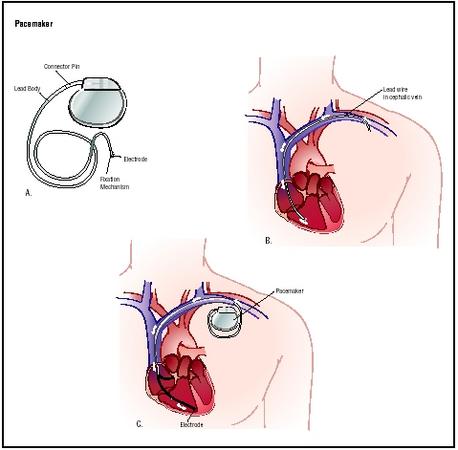 To place a pacemaker, a lead wire is inserted into the cephalic vein of the shoulder and fed into the heart chambers (B). An electrode is implanted in the heart muscle of the lower chamber, and the device is attached (C). (Illustration by Argosy.)