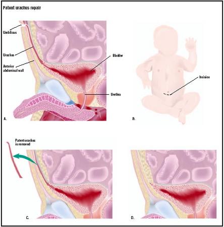 A patent urachus is an abnormal opening from the bladder to the umbilicus, which is retained from fetal life (A). To repair it, an incision is made in the baby's abdomen (B). The patent urachus is removed (C), and the opening to the bladder is closed (D). (Illustration by GGS Inc.)