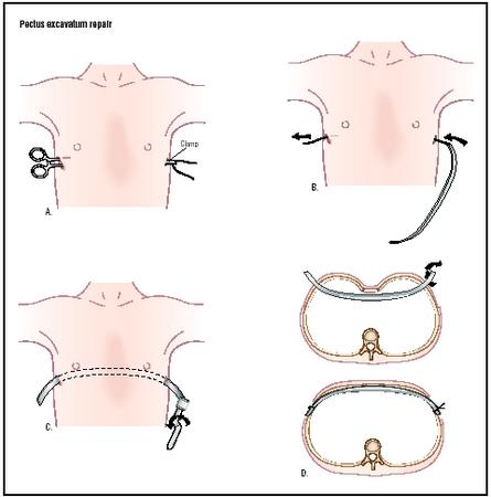 In a minimally invasive pectus excavatum repair, two incisions are made on opposite sides of the chest. A clamp is guided beneath the sternum to create a tunnel for the bar (A), which is then fed through (B). The bar is turned over to push the sternum out (C and D) and attached to the ribcage. (Illustration by Argosy.)