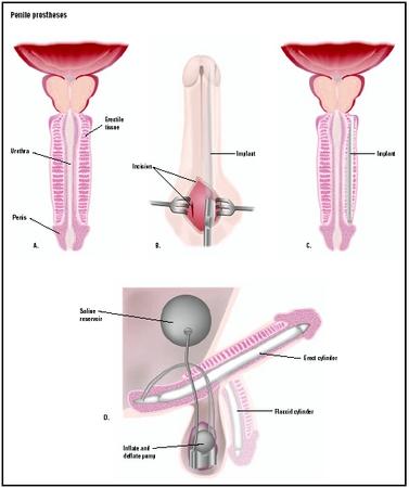 An incision is made at the base of the penis to implant a prosthesis in an area of erectile tissue (B and C). Once in place, a pump placed in the scrotum can be used to inflate and deflate the implant when an erection is desired (D). (Illustration by GGS Inc.)